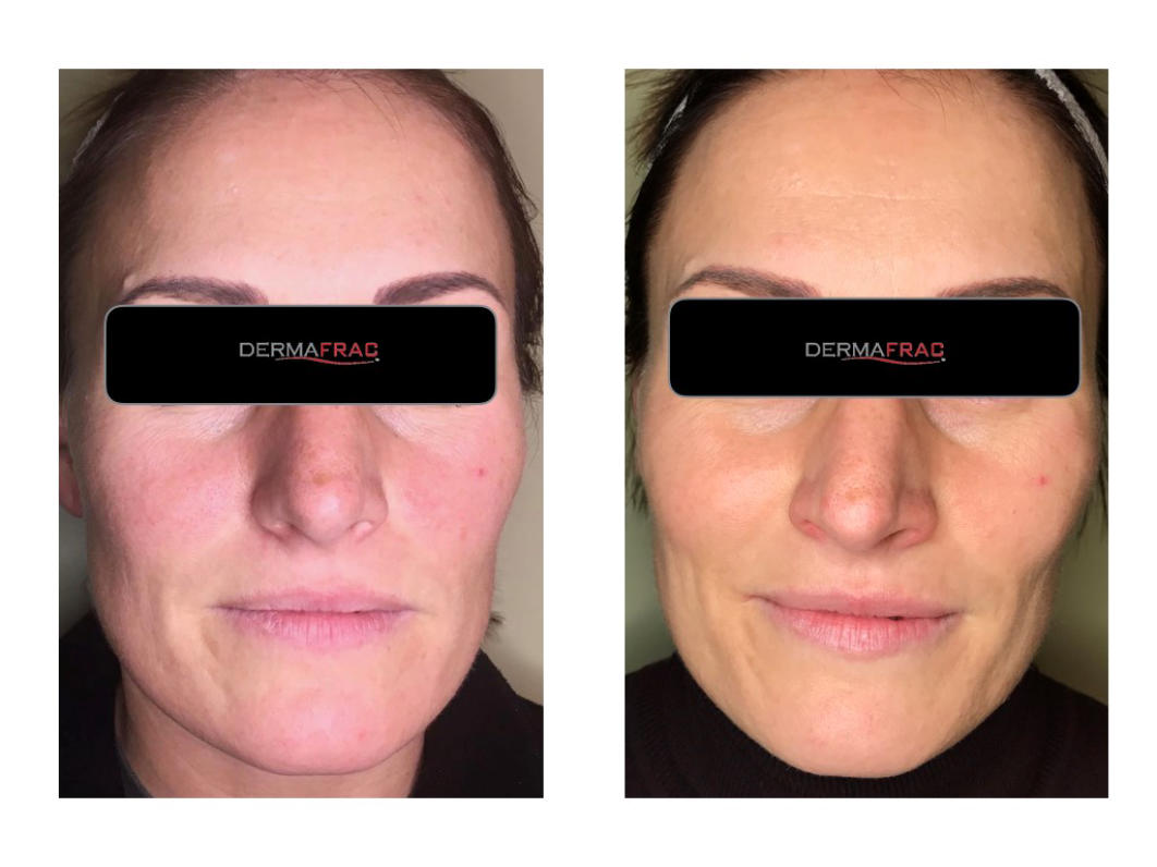 Microdermabrasion Before After Pics.