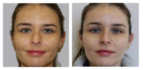 dermafrac vitamin infusion therapy near me